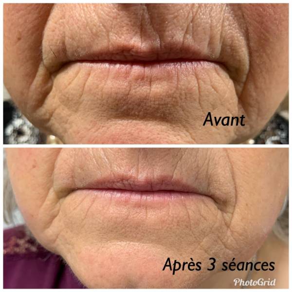 soin visage anti âge pour les rides à l'institut Joali à roanne près de renaison