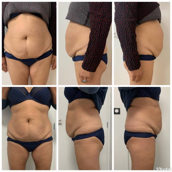 cryolipolyse cure minceur par le froid à roanne près du coteau